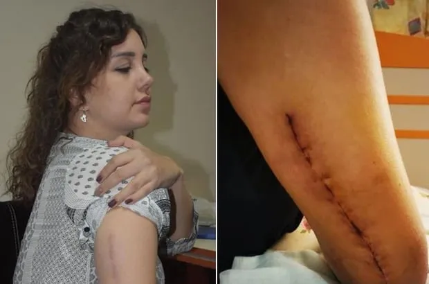 Kız arkadaşının kolunu kıran sanığın cezası istinafta artırıldı